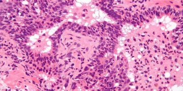 prostate