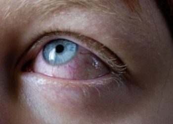 Multisystem Inflammatory Syndrome