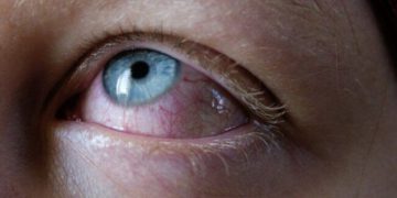 Multisystem Inflammatory Syndrome