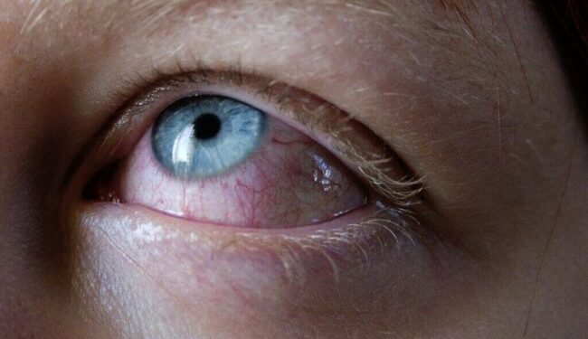 Multisystem Inflammatory Syndrome