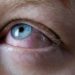 Multisystem Inflammatory Syndrome