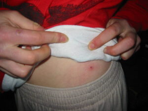 Powassan Virus First Case Reported in Connecticut Powassan virus
