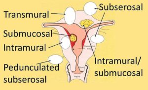July Marks Fibroid Awareness Month fibroid