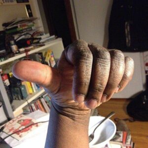 cracked hands