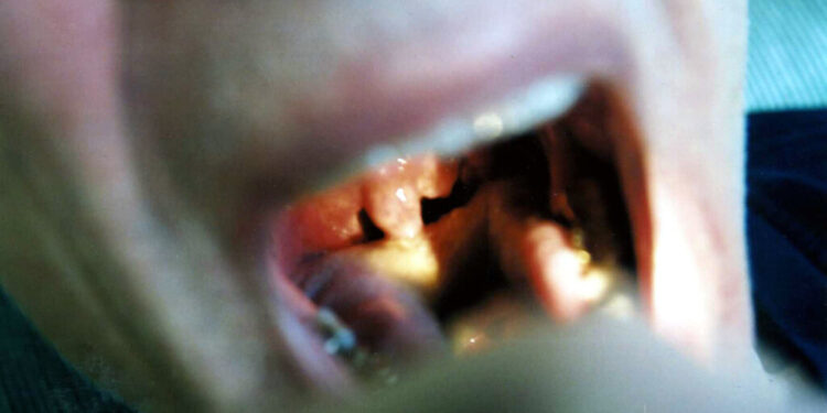throat cancer