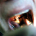 throat cancer