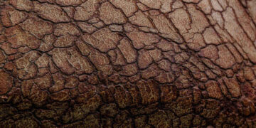 dry skin