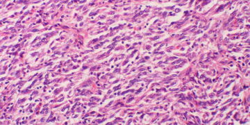 melanoma