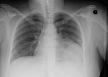 Cancer Lung X-Ray