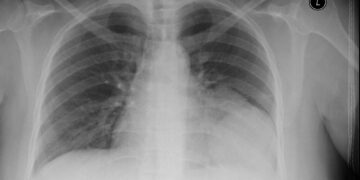 Cancer Lung X-Ray