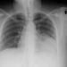 Cancer Lung X-Ray