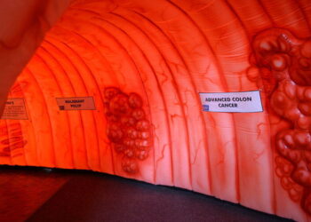 Colon Cancer