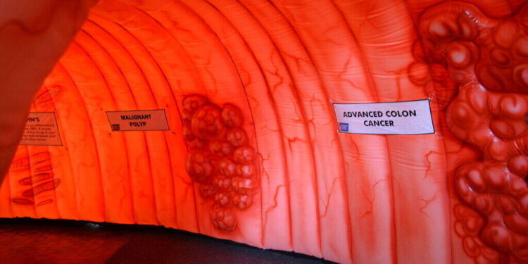 Colon Cancer