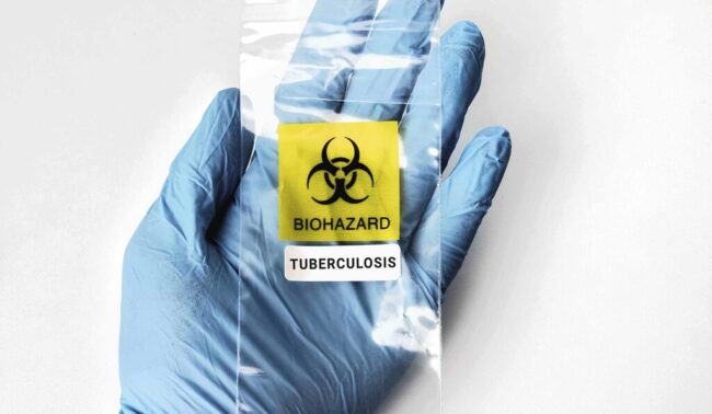 Government Negligence Leads to Tuberculosis Outbreak Among 55 Migrants Migrant