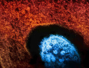 Measles 