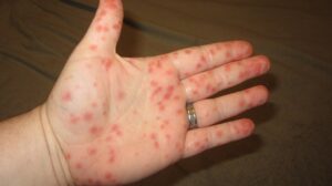 Measles 