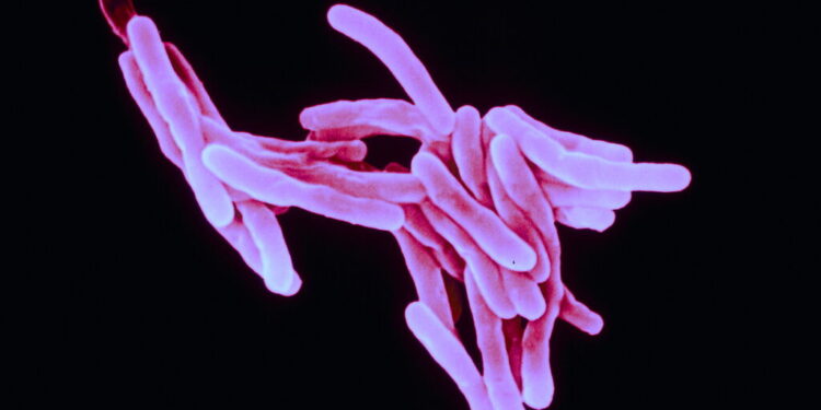 Tuberculosis