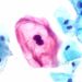 cancer